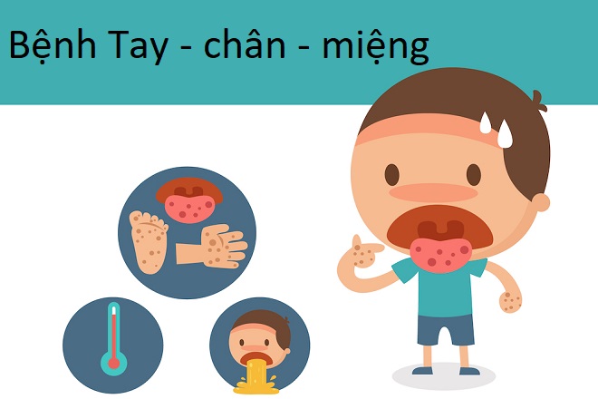 Bệnh tay chân miệng