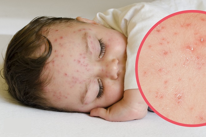 Bệnh thủy đậu