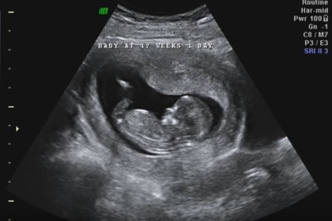 Kinh ngạc trước hình ảnh thai nhi 14 tuần tuổi xem xong những người có ý  định phá thai phải suy nghĩ lại