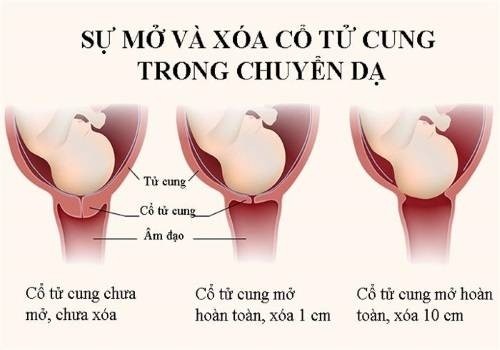 Các thay đổi ở cổ tử cung trong quá trình chuyển dạ